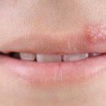 Herpes