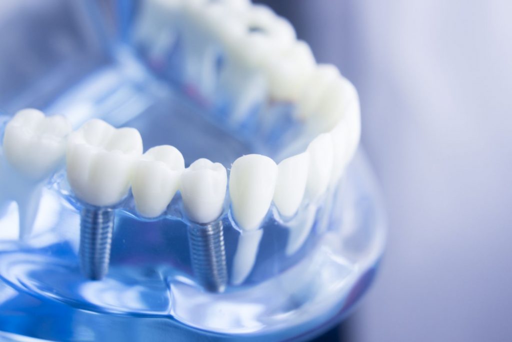 Wie viele Implantate?