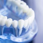 Wie viele Implantate?